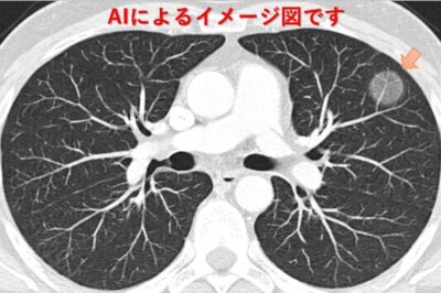 肺がん検診「異常なし」で安心？のアイキャッチ画像
