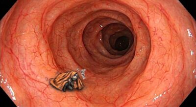 見つけにくい大腸ポリープとは_内視鏡専門医が解説のアイキャッチ画像