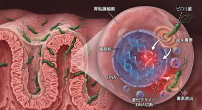 「除菌したから、もう安心」？_ピロリ菌とはのアイキャッチ画像